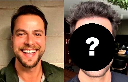 Antes e Depois do ex-BBB Gustavo Marsengo após procedimentos estéticos